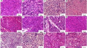 Nasopharyngeal-carcinoma-620x342